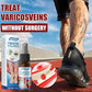 South Moon - Varicose Veins